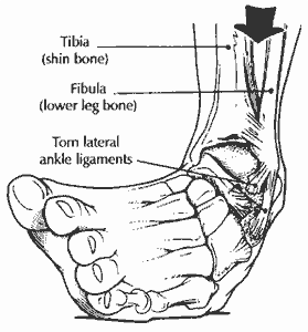 sprain diagram